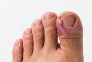 Ingrown toenail