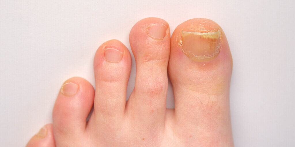 Thickened toenails